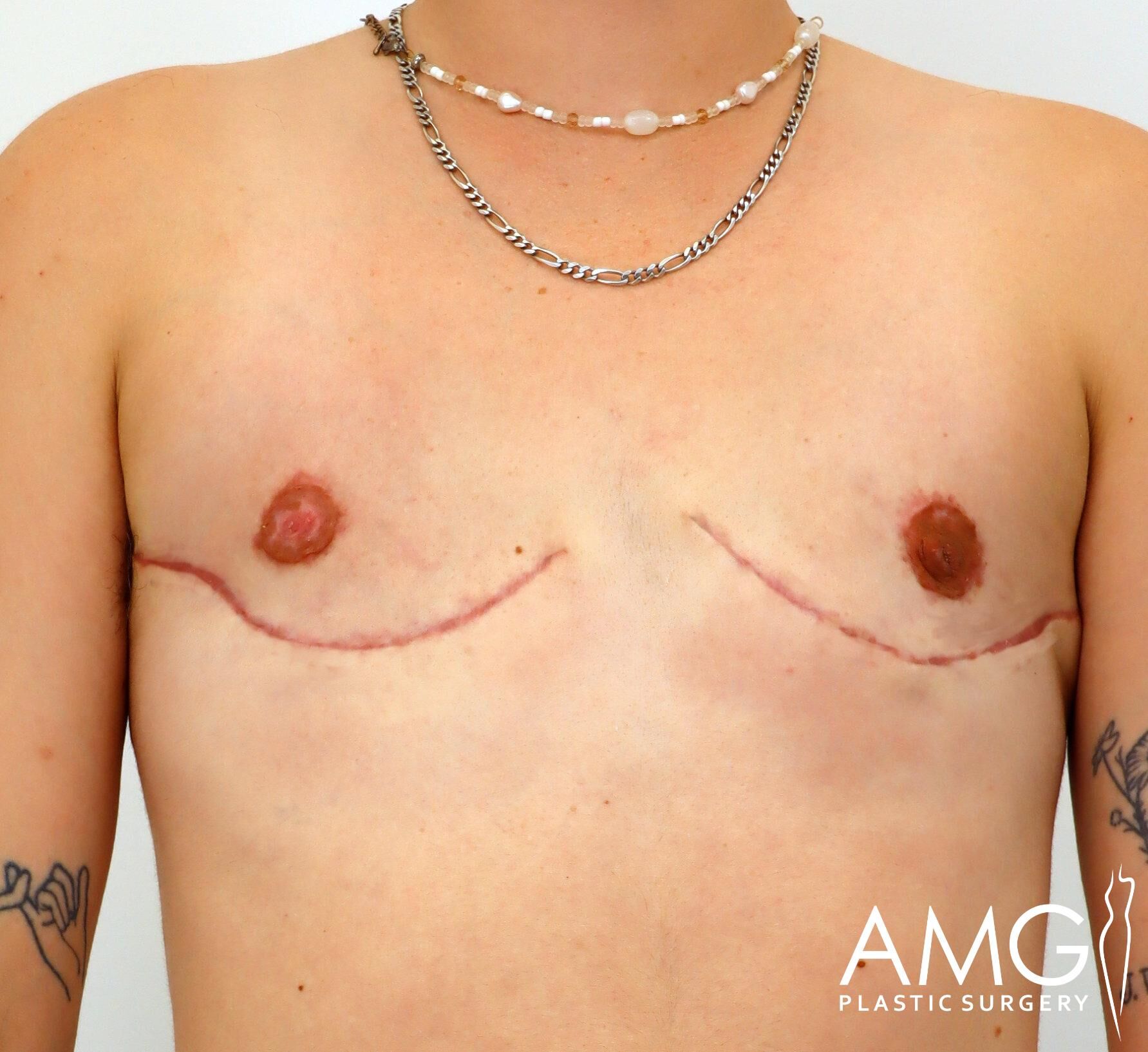 Close-up of a person's chest post-top surgery, showing healing scars below the nipples, with tattoos on both arms. They're wearing a necklace.