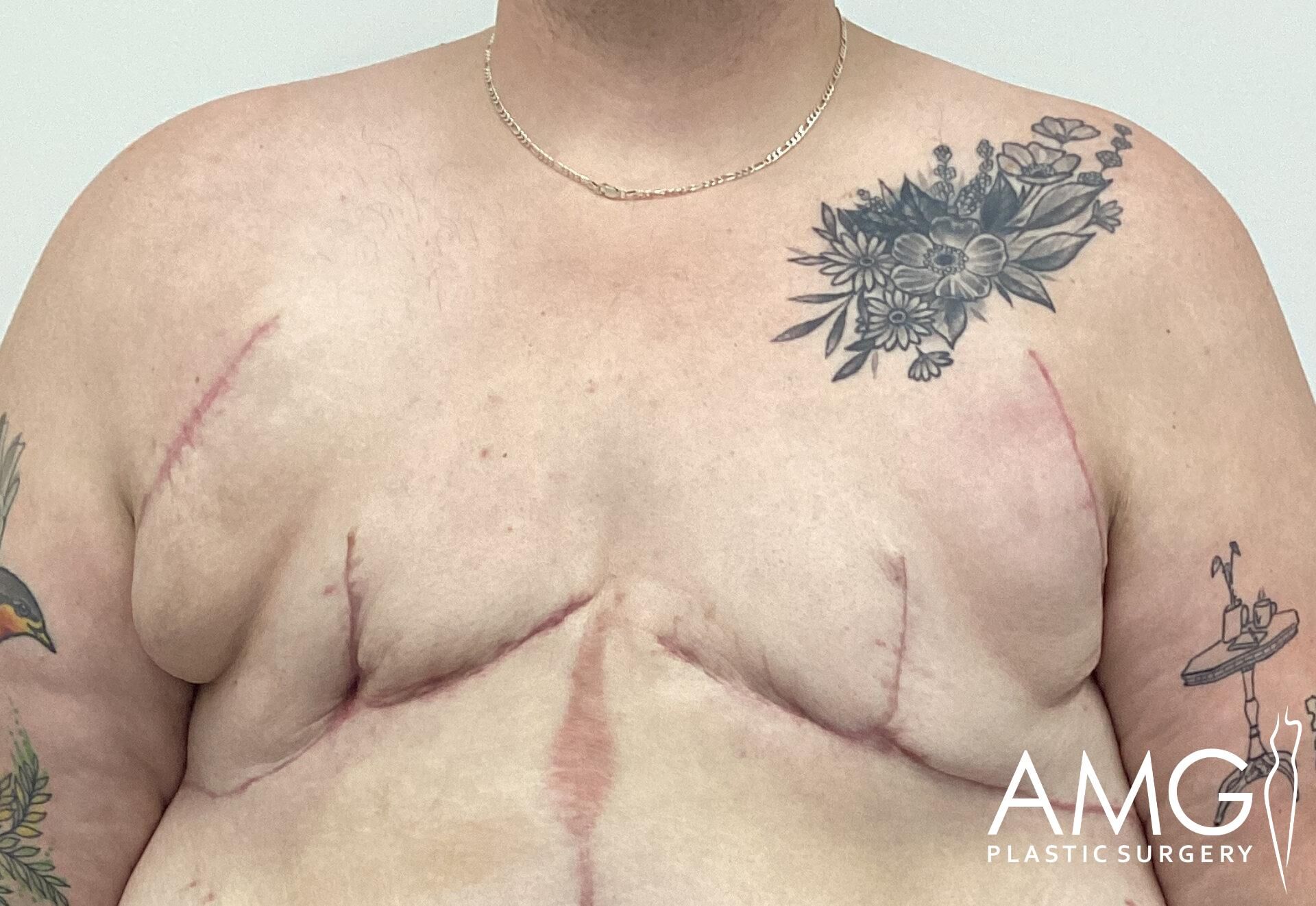 A person with surgical scars on the chest and floral tattoos on the shoulders and right side. 