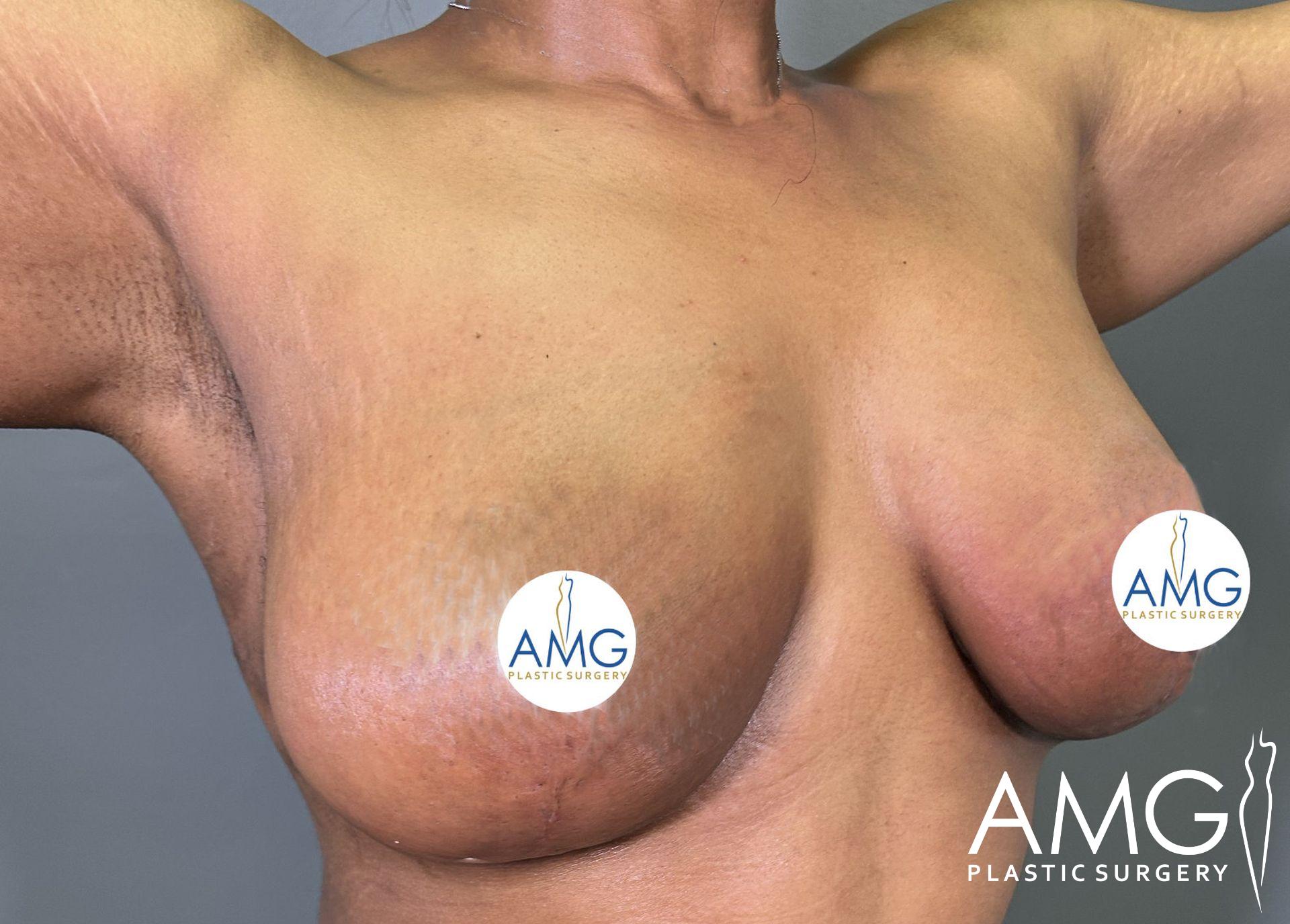 A person with arms raised, wearing circular pasties and a visible AMG Plastic Surgery watermark.