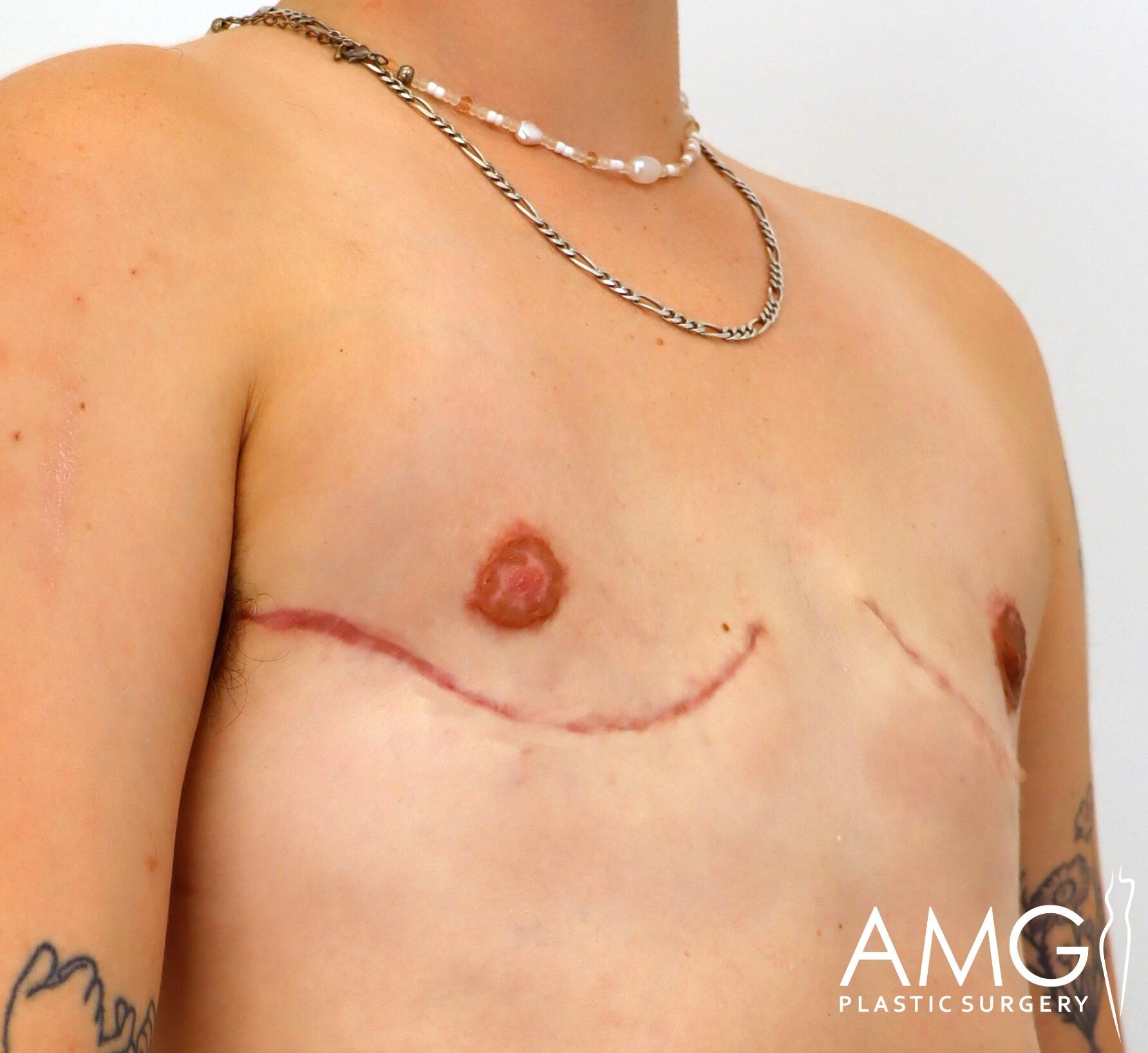 Close-up of a person's chest with visible surgical scars and tattoos on the arms, wearing two necklaces. Logo in the corner reads "AMG Plastic Surgery.