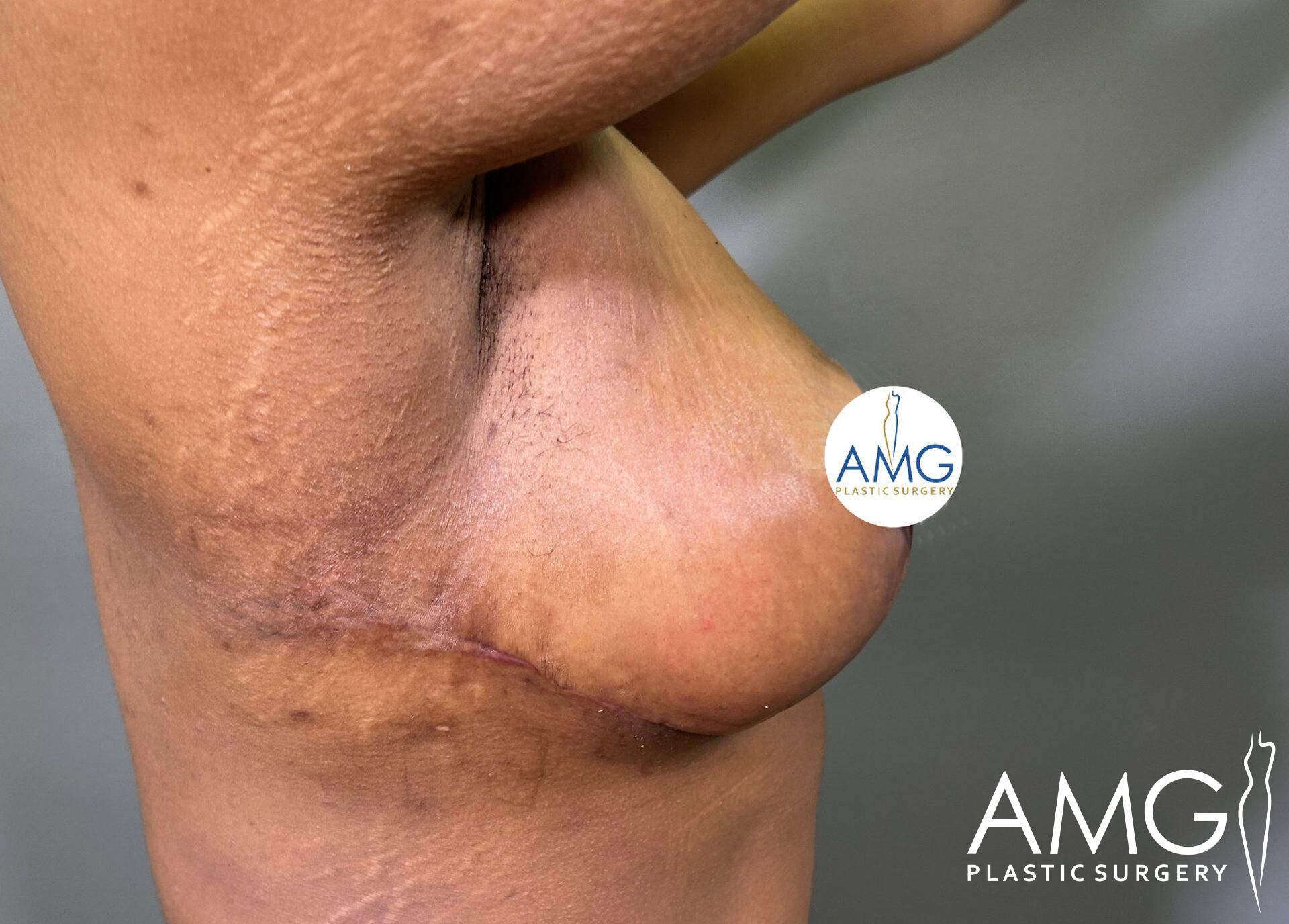 Side view of a person's underarm and breast showing surgical scars. Logo for AMG Plastic Surgery in corner.