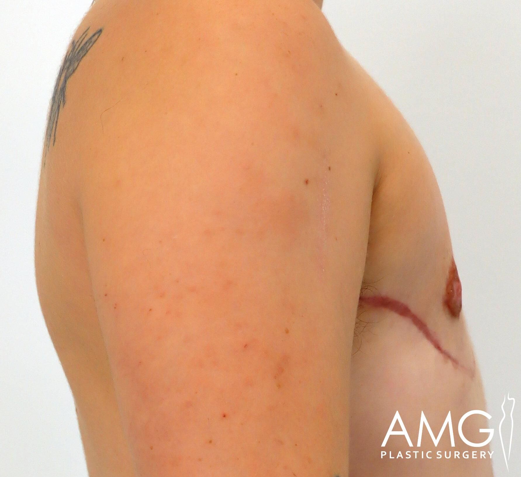 Side view of an upper body showing a post-surgery scar under the chest, with a tattoo on the shoulder. The image has the AMG Plastic Surgery logo in the bottom right corner.