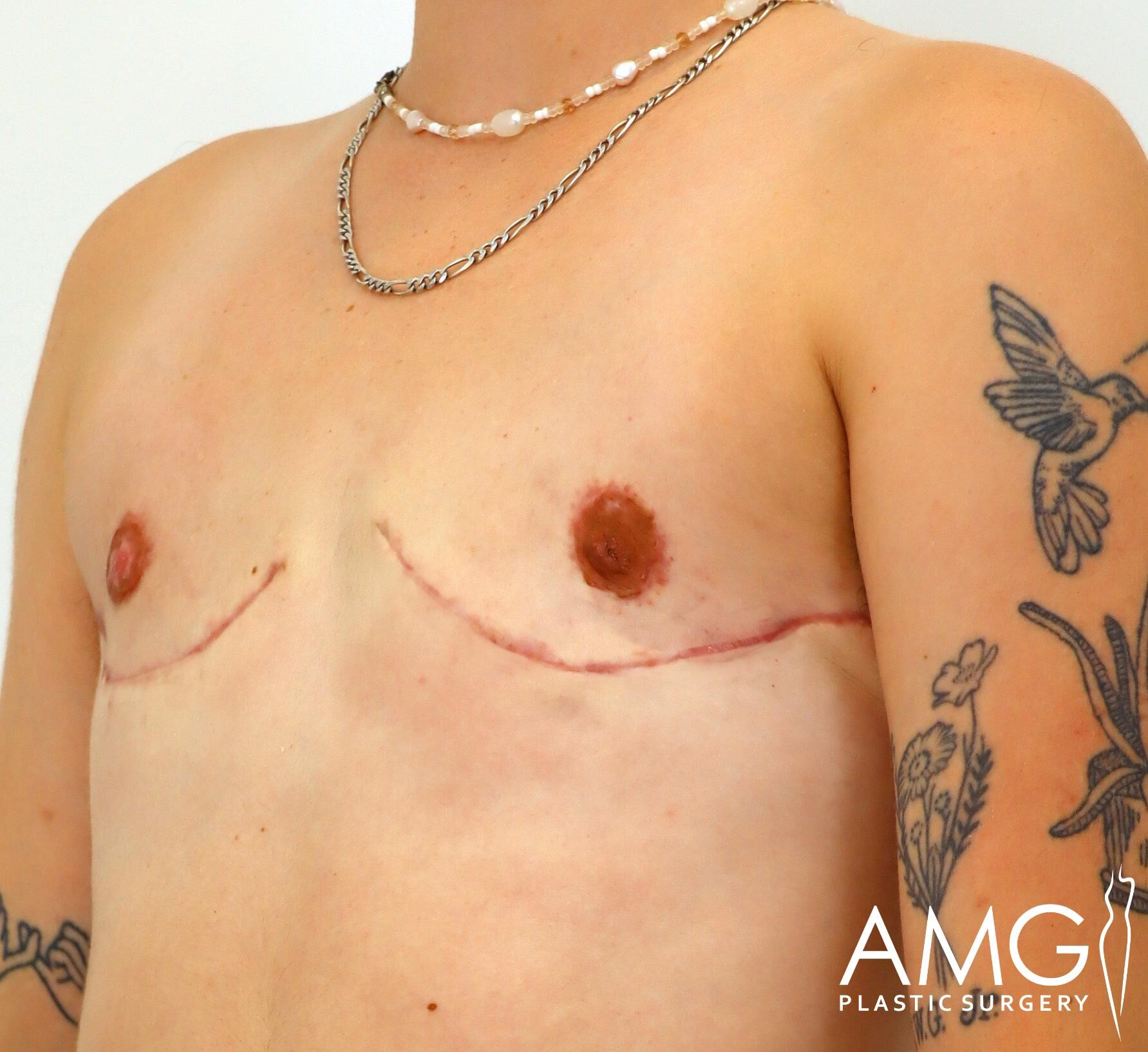 Person with chest scars and tattoos, wearing a necklace, showing results of top surgery. Logo "AMG Plastic Surgery" visible in corner.