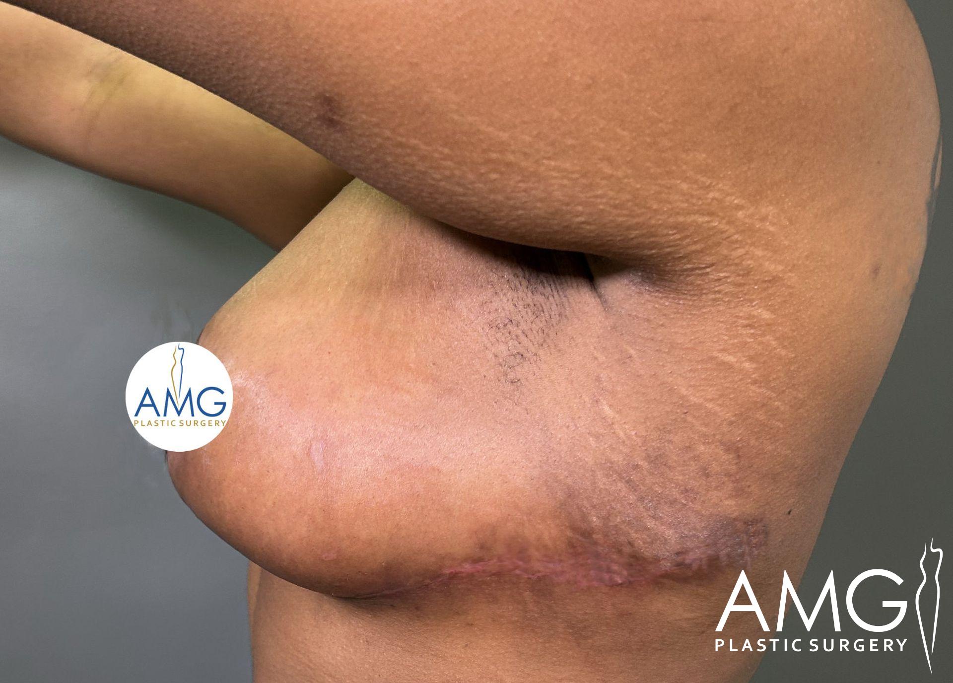 Close-up of a person's side and armpit area showing scar and stretch marks, with an AMG Plastic Surgery logo in the corner.