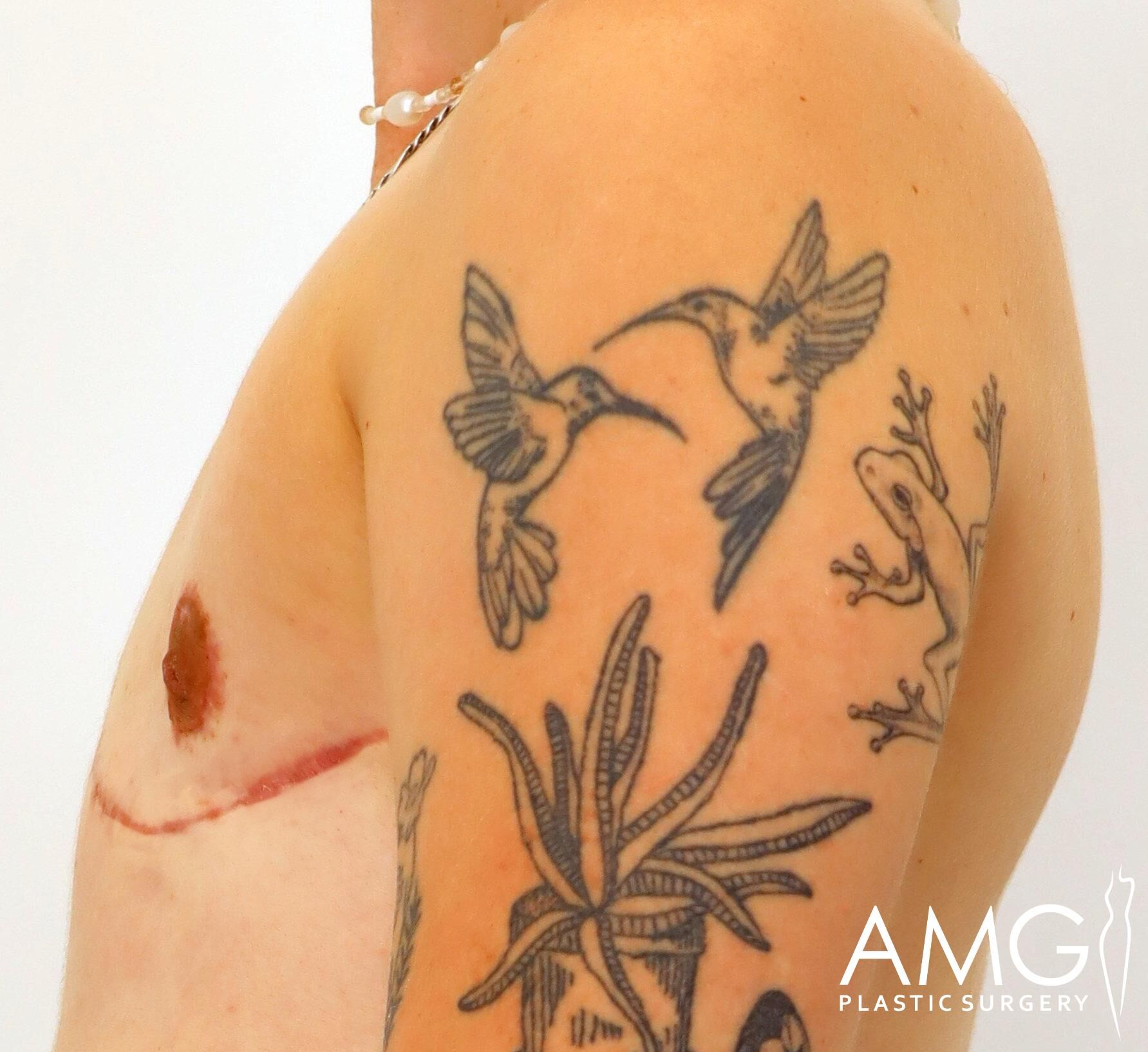 Upper arm with tattoos including hummingbirds and a frog, a surgical scar across the chest, and the AMG Plastic Surgery logo in the corner.