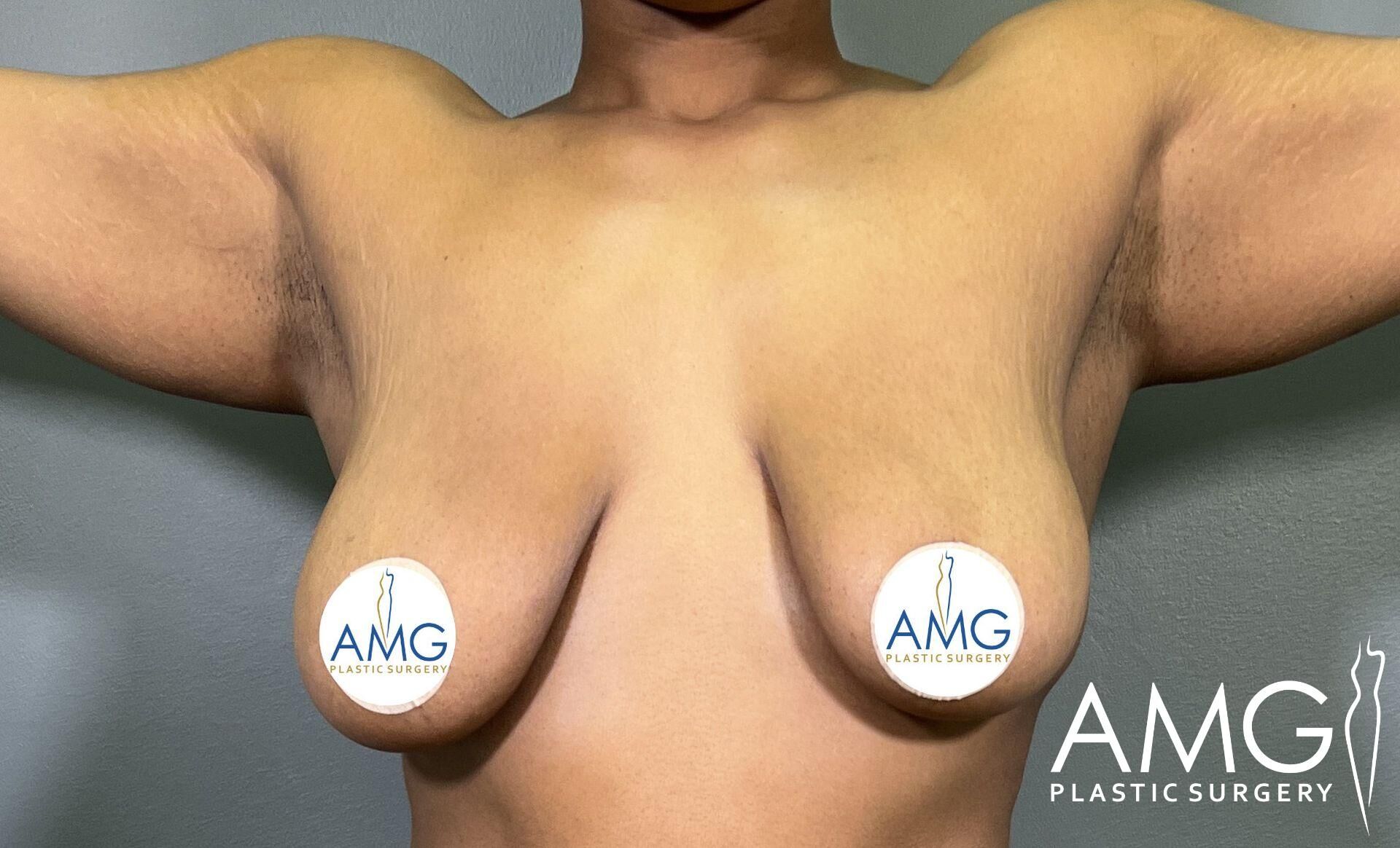 Person with arms outstretched, showing a frontal view. Nipples are covered with AMG Plastic Surgery logos.