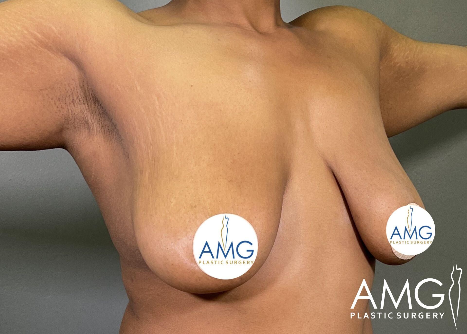 Close-up of a person’s upper body showing the results of a cosmetic breast surgery, with logos covering the nipples. The logo for AMG Plastic Surgery is displayed in the bottom right corner.