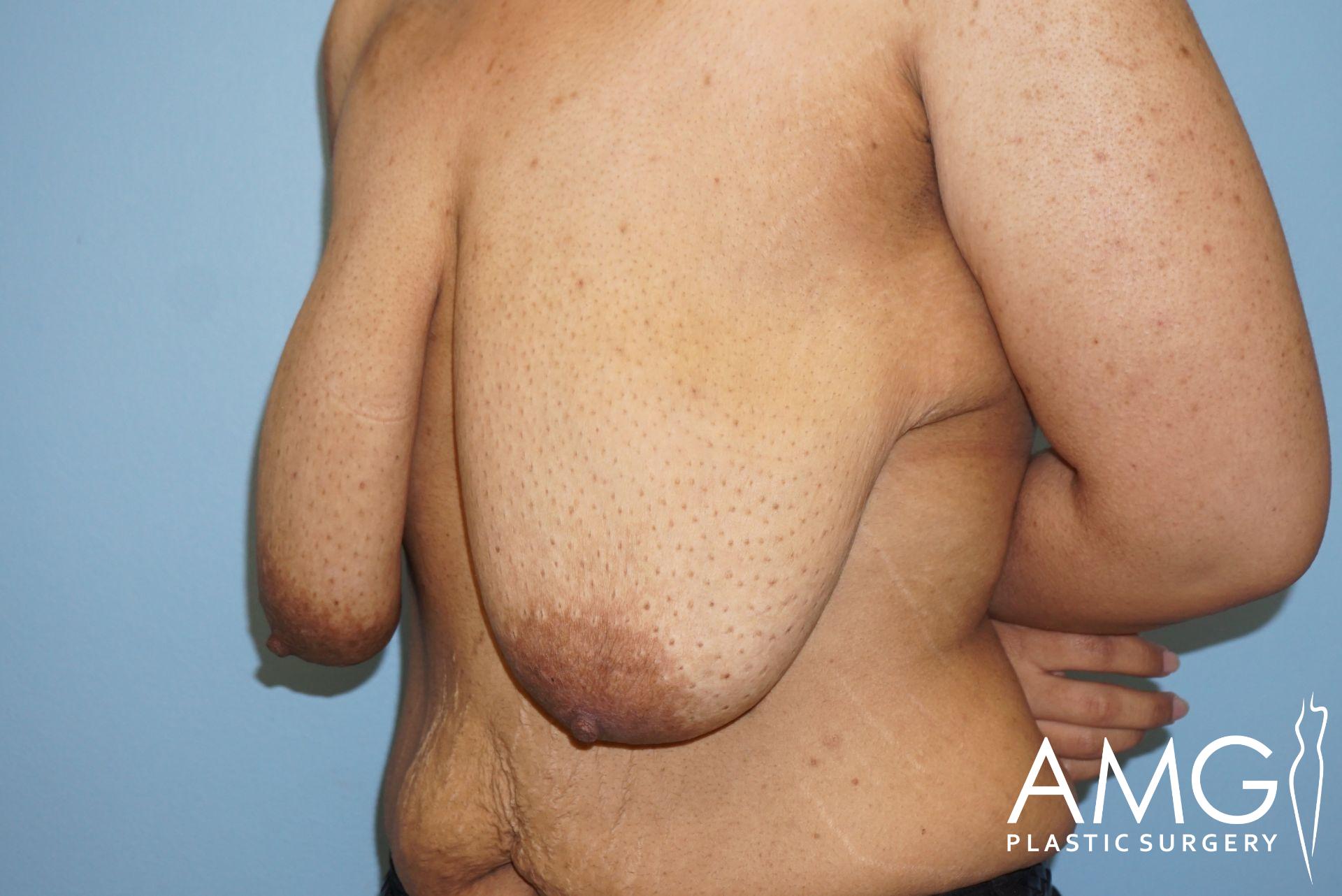 The image shows a person with significant excess skin and sagging breasts standing against a blue background, with arms partially visible. "AMG Plastic Surgery" is written in the bottom right corner.