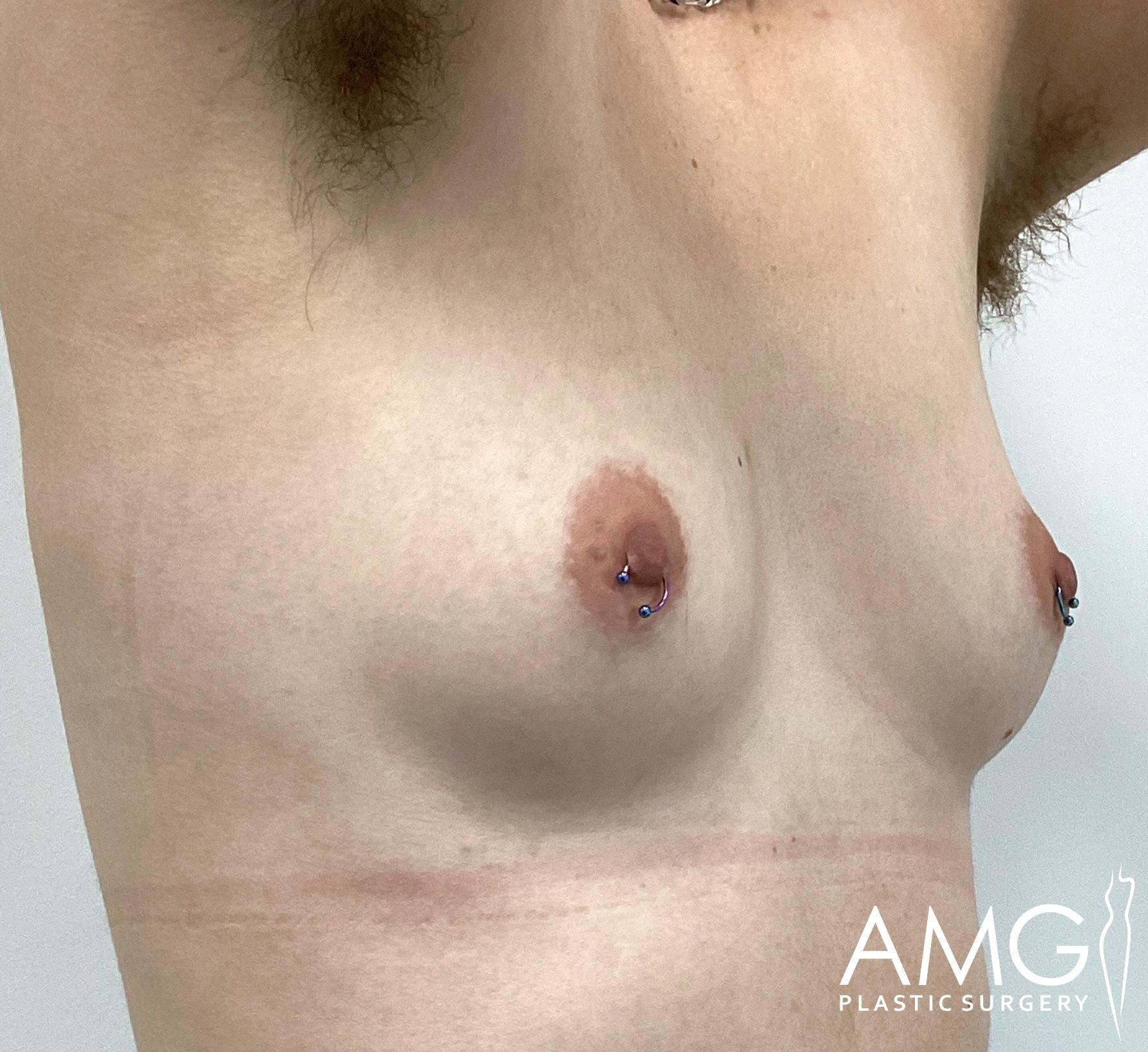 Chest with tattooed areolas and nipple piercings, with a faint horizontal scar visible below.