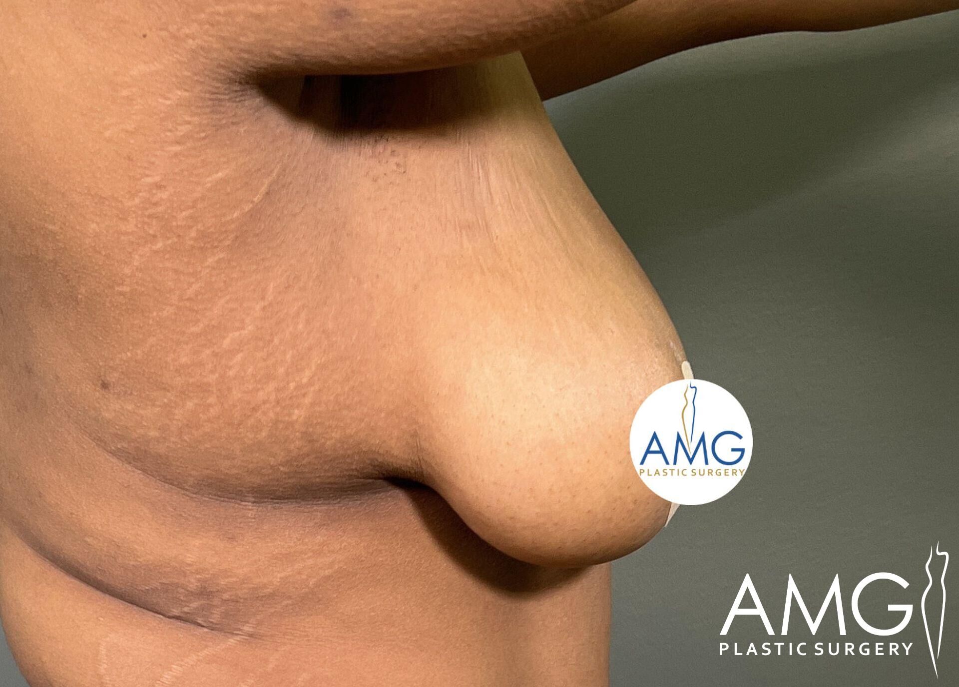 Close-up of a person’s skin with visible stretch marks and loose tissue. The image features logos for AMG Plastic Surgery.