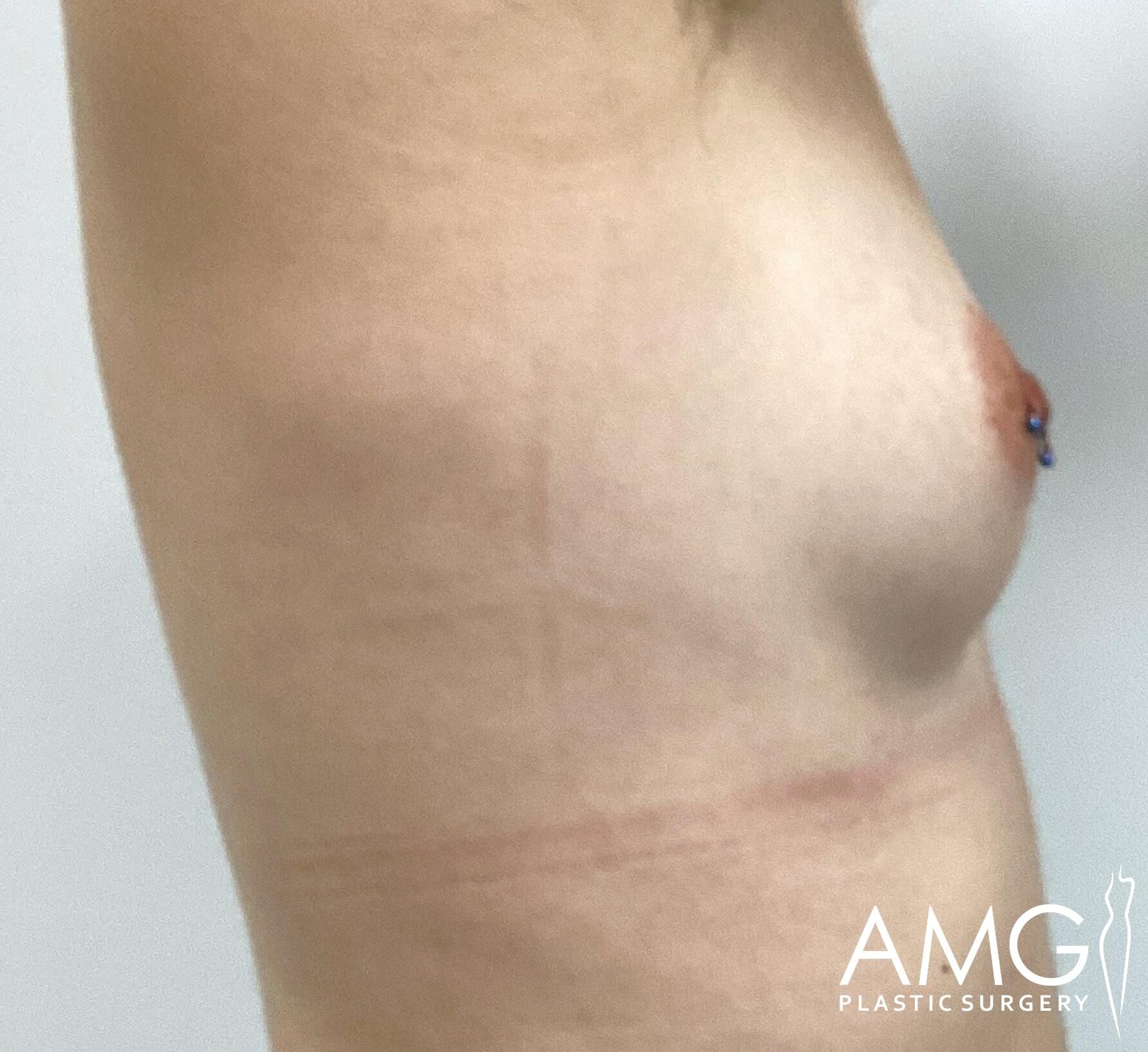 Side view of a person's torso showing a prominent breast on the right. The image has the AMG Plastic Surgery logo in the corner.