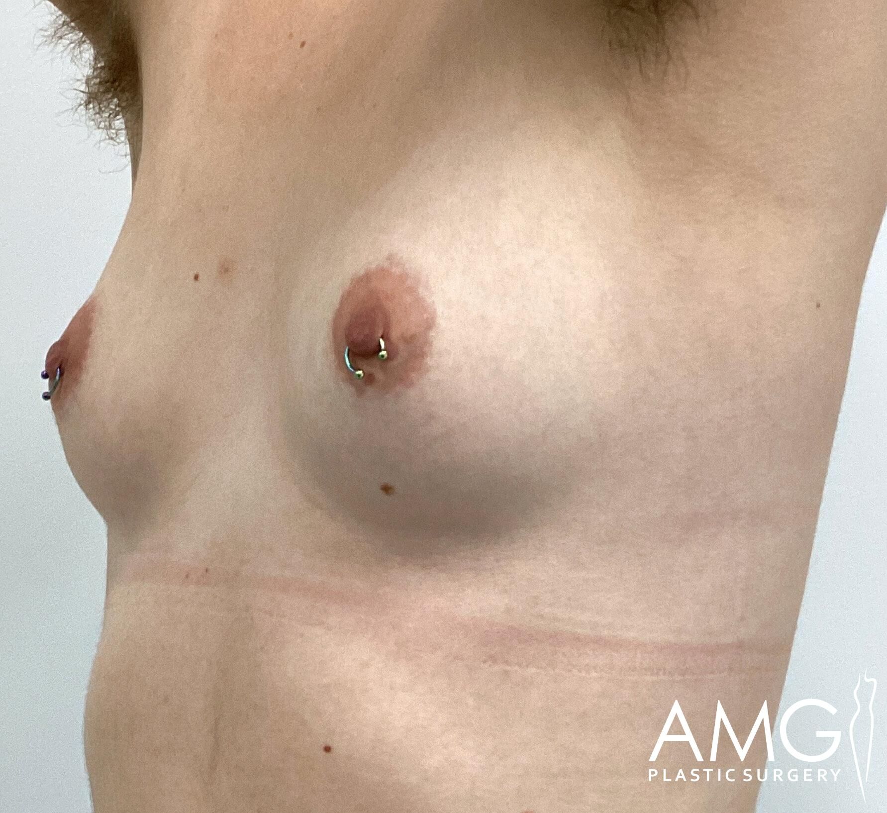 A person's chest with nipple piercings, showing faint surgical scars below the breasts. Logo in the corner reads "AMG Plastic Surgery.