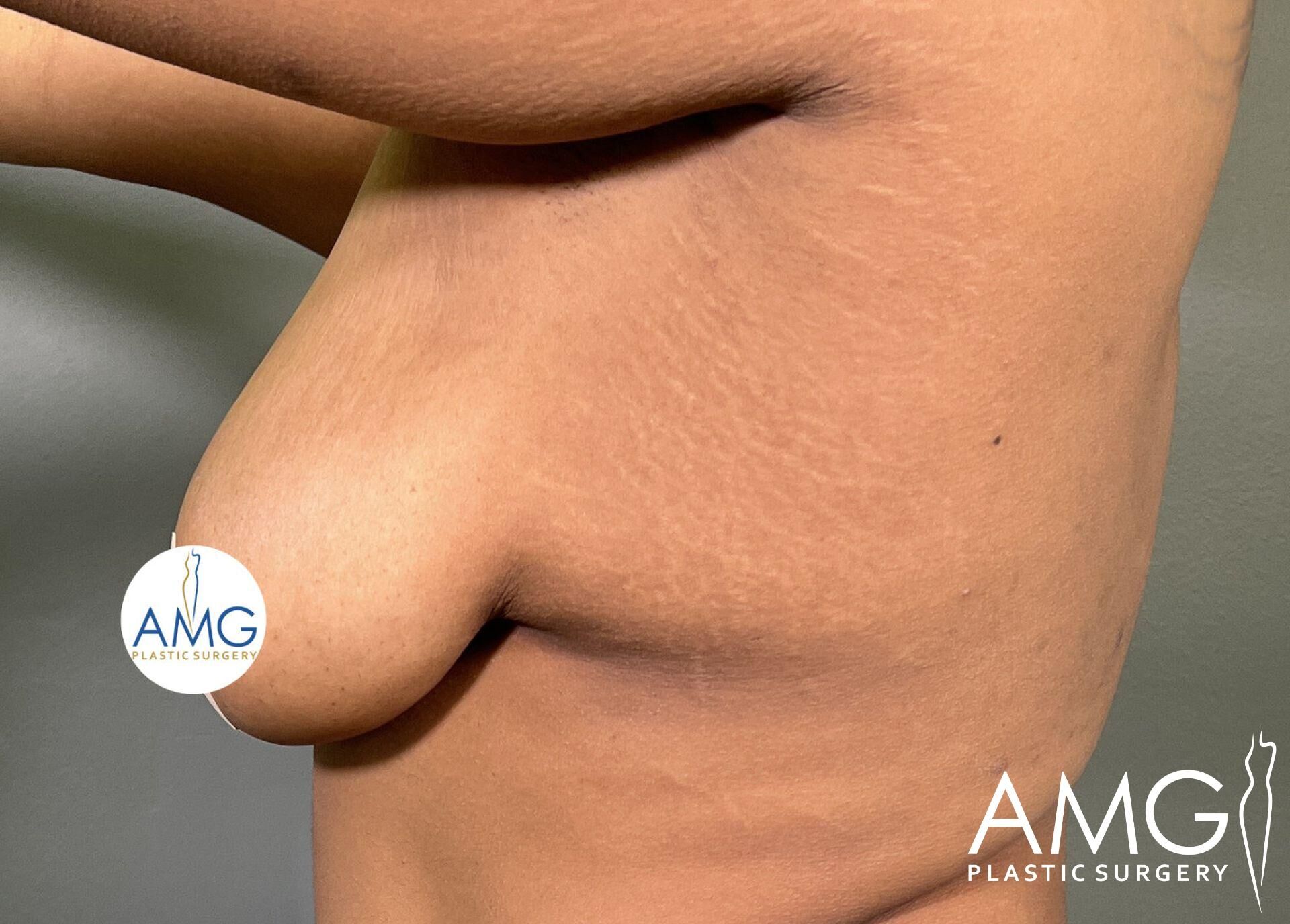 Side view of a person's torso with visible stretch marks and sagging skin, displaying the AMG Plastic Surgery logo in two places.