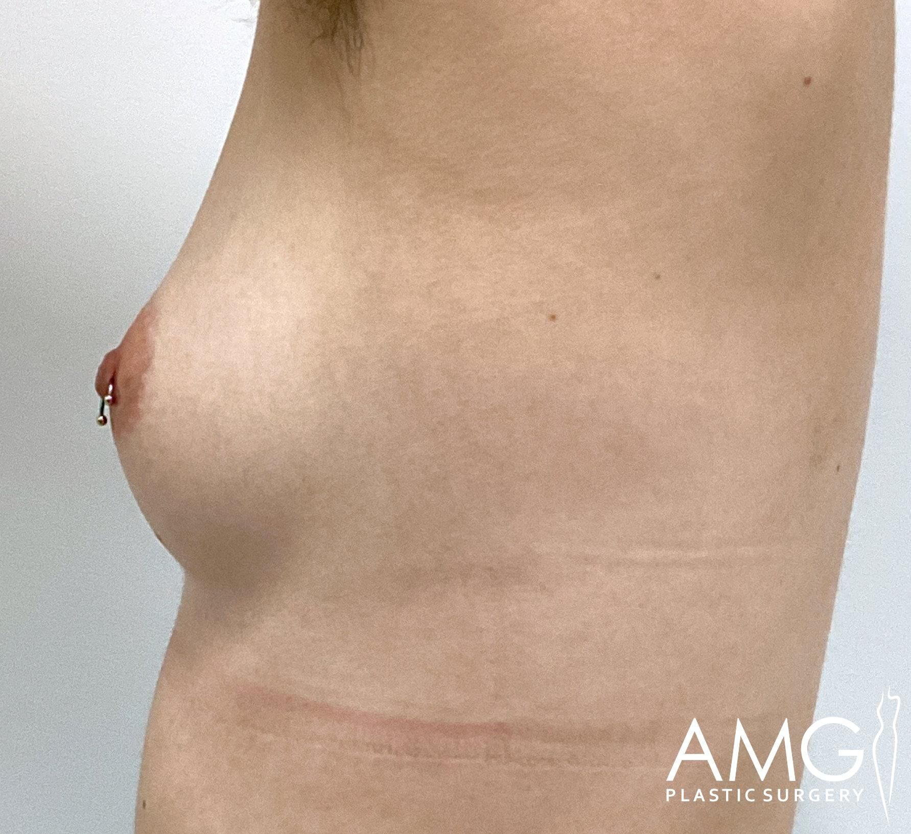 Side profile of an unclothed torso with visible stretch marks and a nipple piercing. A logo for AMG Plastic Surgery is in the bottom right corner.