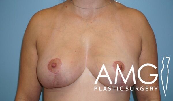 A woman’s chest showing post-surgical scars and asymmetry after breast reconstruction, with a logo reading “AMG Plastic Surgery” in the bottom right corner.