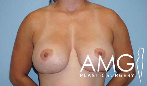A womans bare chest after breast surgery, showing asymmetrical breasts with surgical scars. The image features the AMG Plastic Surgery logo in the bottom right corner.