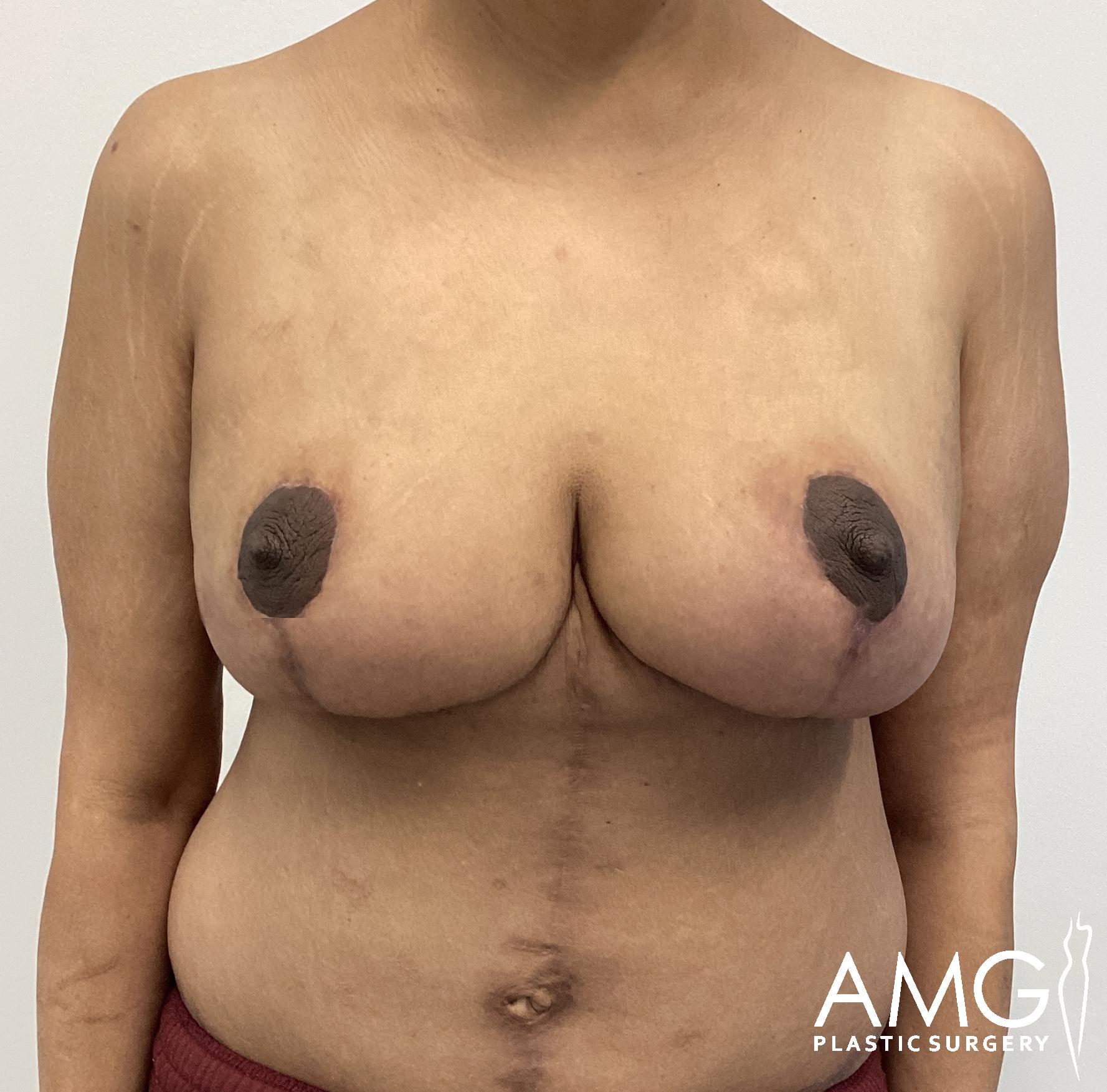A person with visible scarring and pigmentation differences on their chest, standing in front of a plain background. 