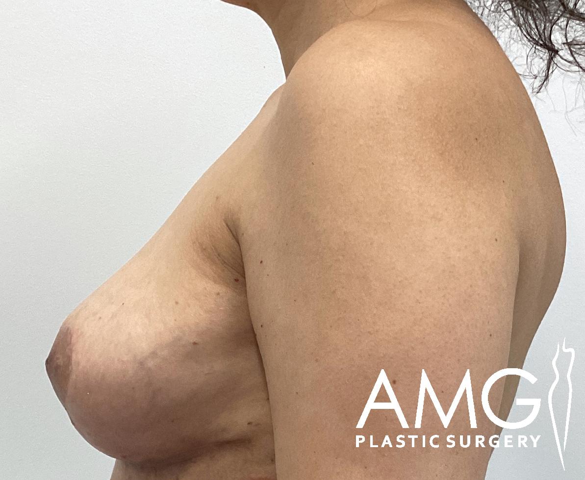 Side view of a woman's torso showing breast augmentation results, with a logo for AMG Plastic Surgery in the corner.