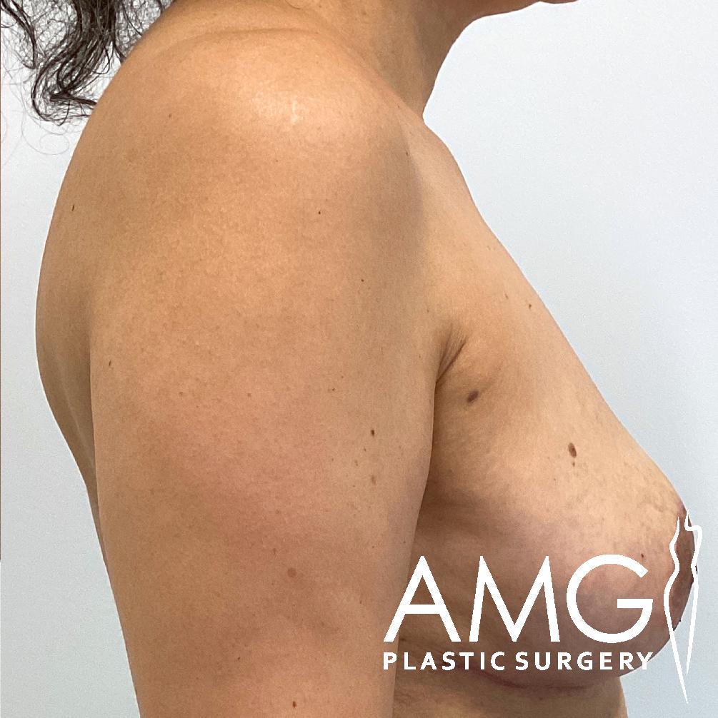 Side view of a person's upper body showing the shoulder, arm, and torso. The image has a logo in the bottom right corner that reads "AMG Plastic Surgery.
