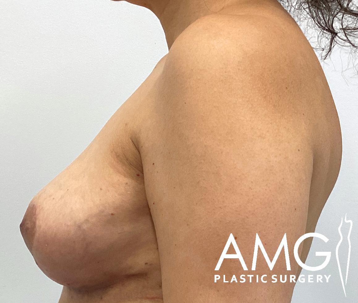 Side view of a person’s bare torso showing the profile of their chest. Logo for AMG Plastic Surgery is visible in the bottom right corner.