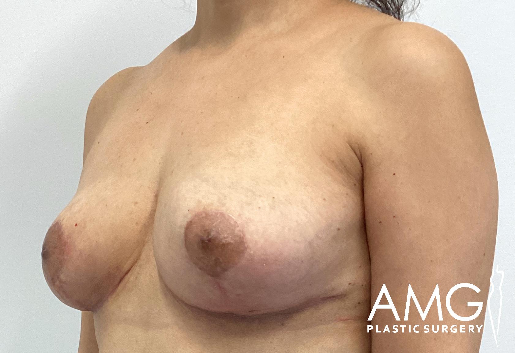 Person showing post-surgery results with visible incisions on the chest, standing against a plain white background. "AMG Plastic Surgery" logo in the corner.