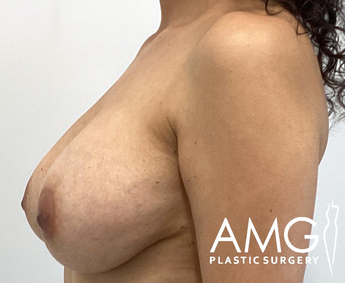 Profile view of a person’s bare torso showing a surgical alteration. The image features the logo of AMG Plastic Surgery.