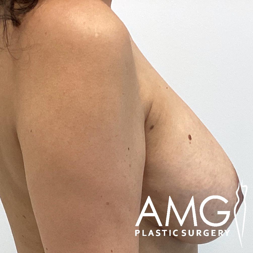 Right side view of a woman’s lower face and neck after chin liposuction, showing improved contour and jawline definition at AMG Plastic Surgery in Herndon, VA.
