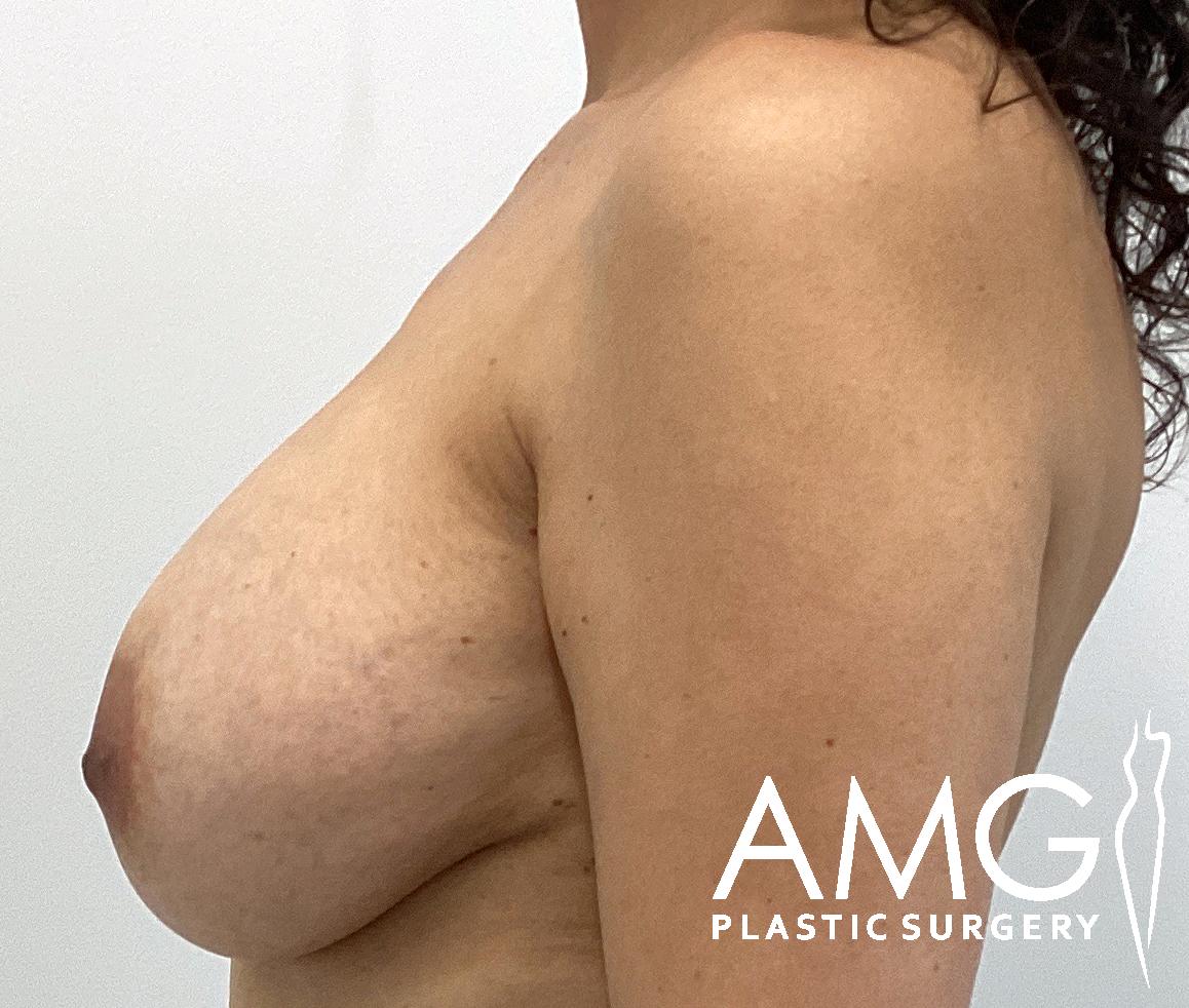 Side profile of a person’s chest, showing the effects of plastic surgery. Logo in the corner reads "AMG Plastic Surgery.