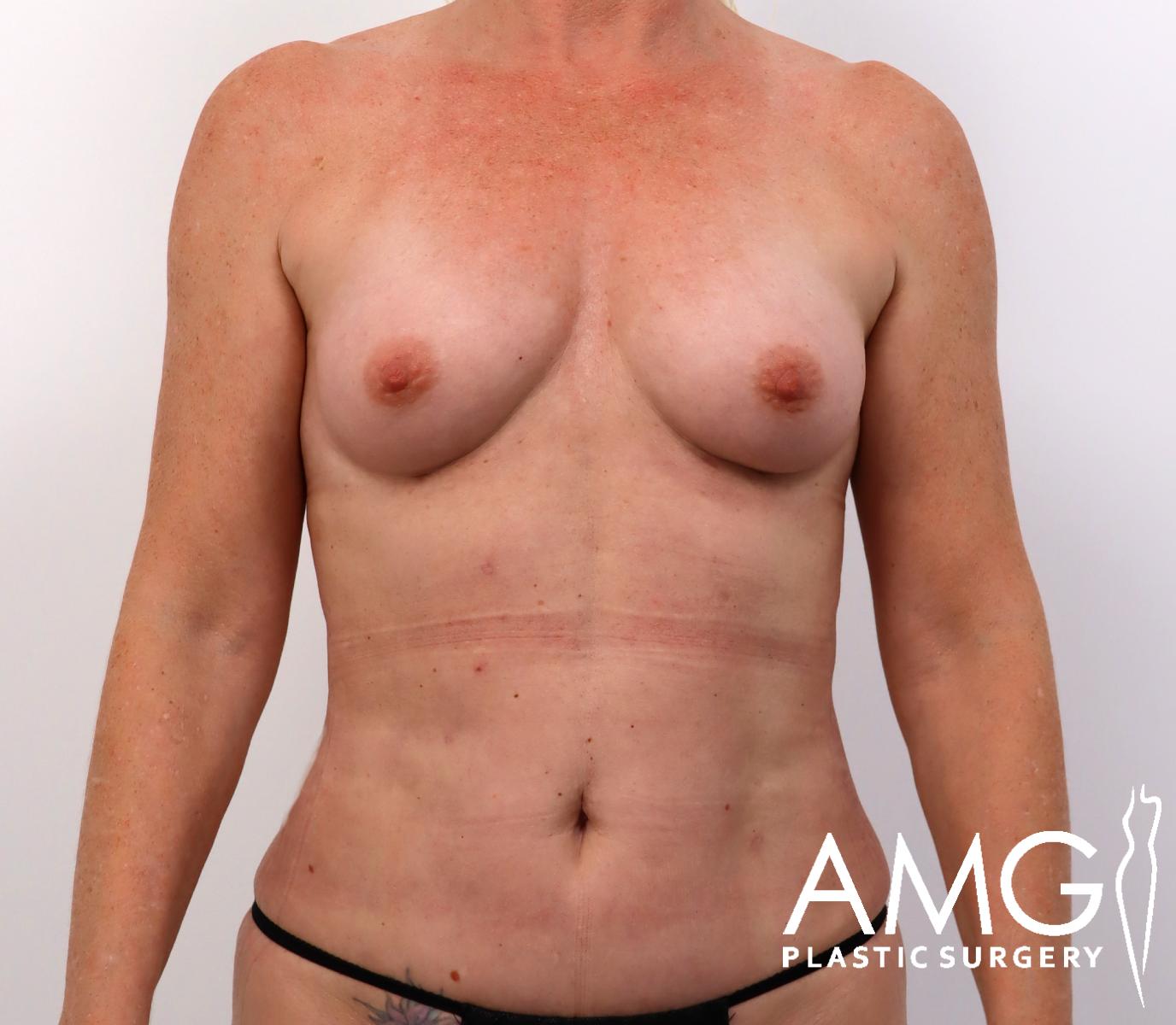 A person with visible post-surgical scars on the chest and lower abdomen stands facing forward. The AMG Plastic Surgery logo is in the bottom right corner.