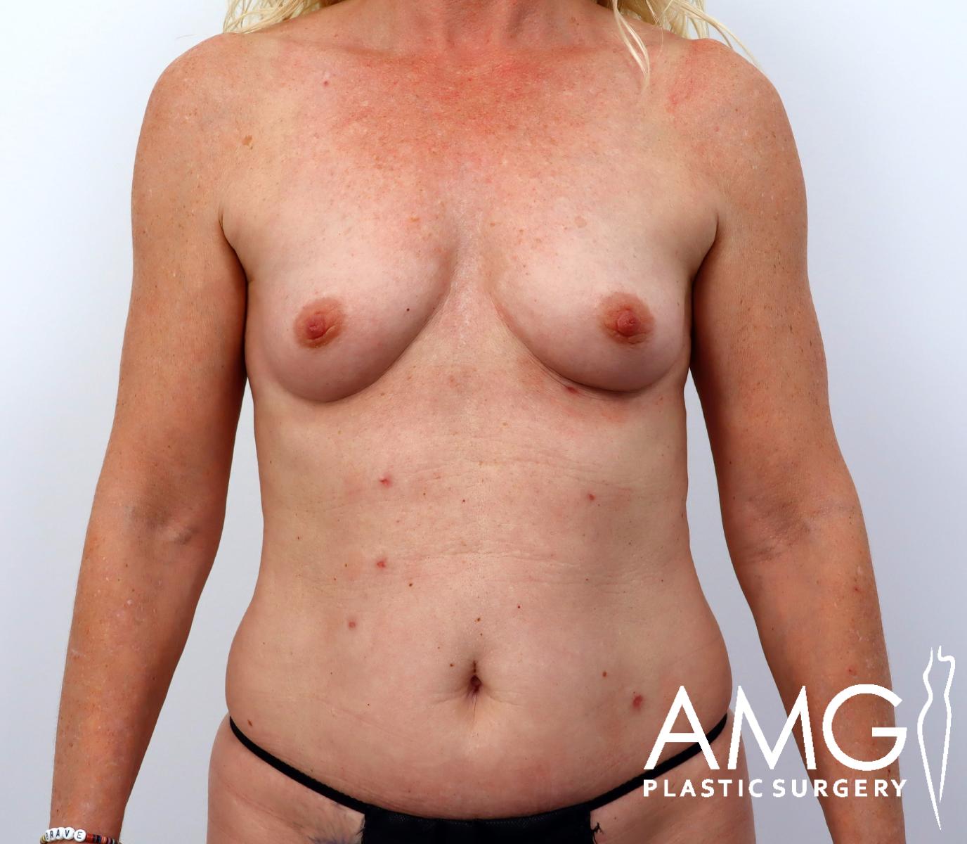 A woman with visible surgical scars on her breasts and lower abdomen stands against a plain background. The logo AMG Plastic Surgery appears in the lower right corner.