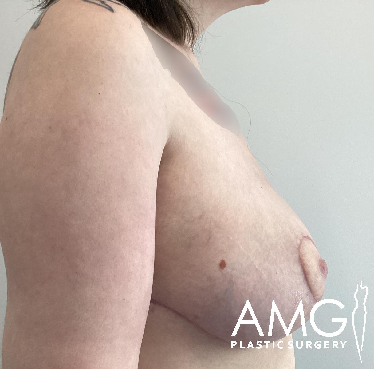 Side view of a persons chest and upper arm showing post-surgical scars on the breast; the image is branded with AMG Plastic Surgery in the bottom right corner.