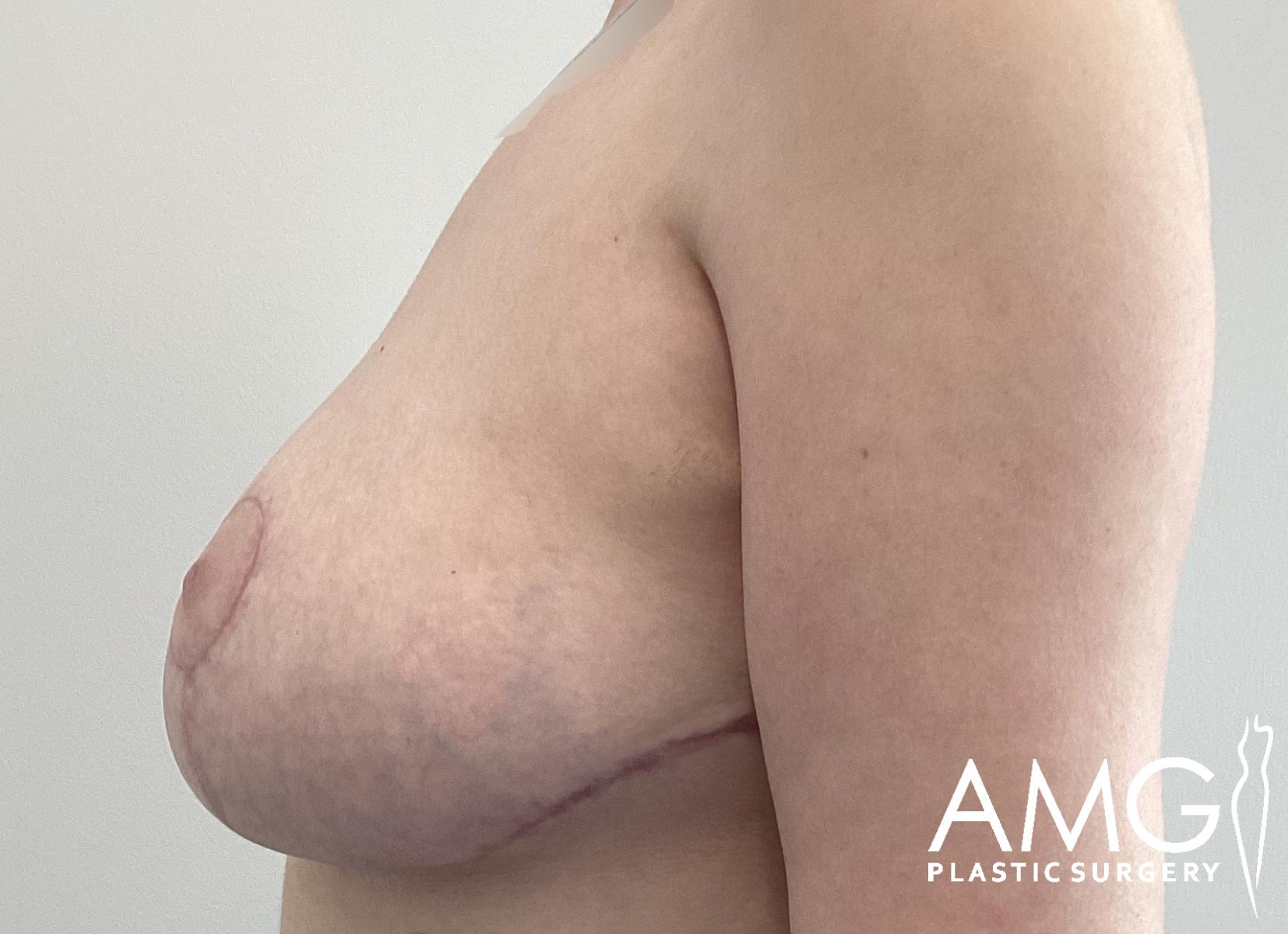 Side view of a person’s chest showing post-surgical scars on the breast. The image has a watermark in the lower right corner that reads AMG Plastic Surgery.