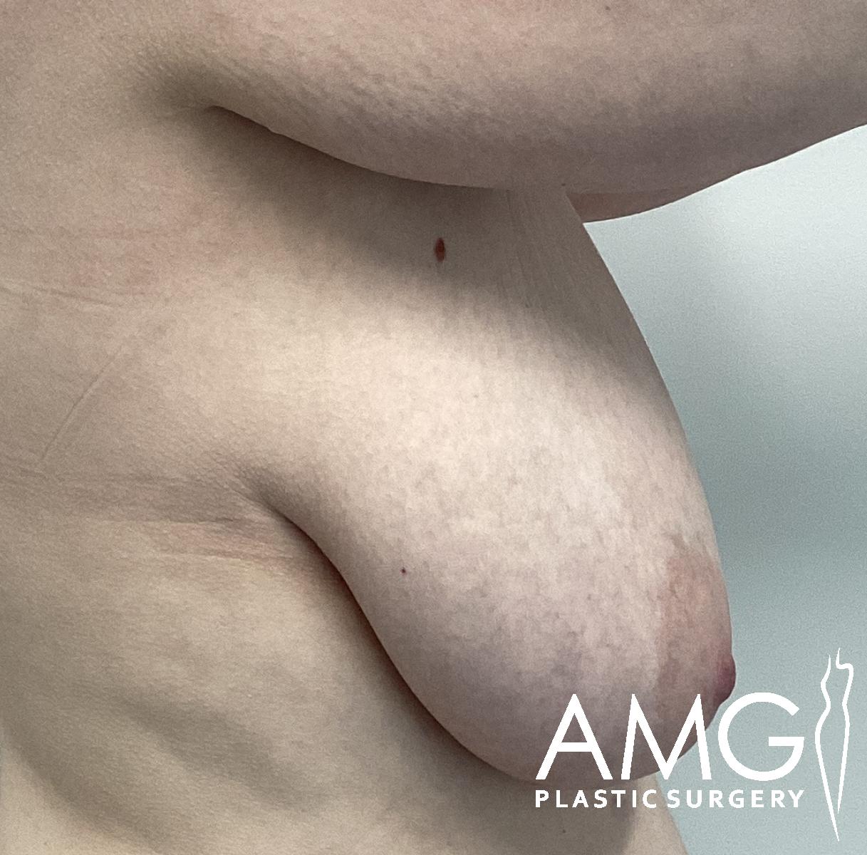 Side view of a person’s bare chest with significant breast sagging. The logo AMG Plastic Surgery is visible in the lower right corner. The background is blurred and neutral.