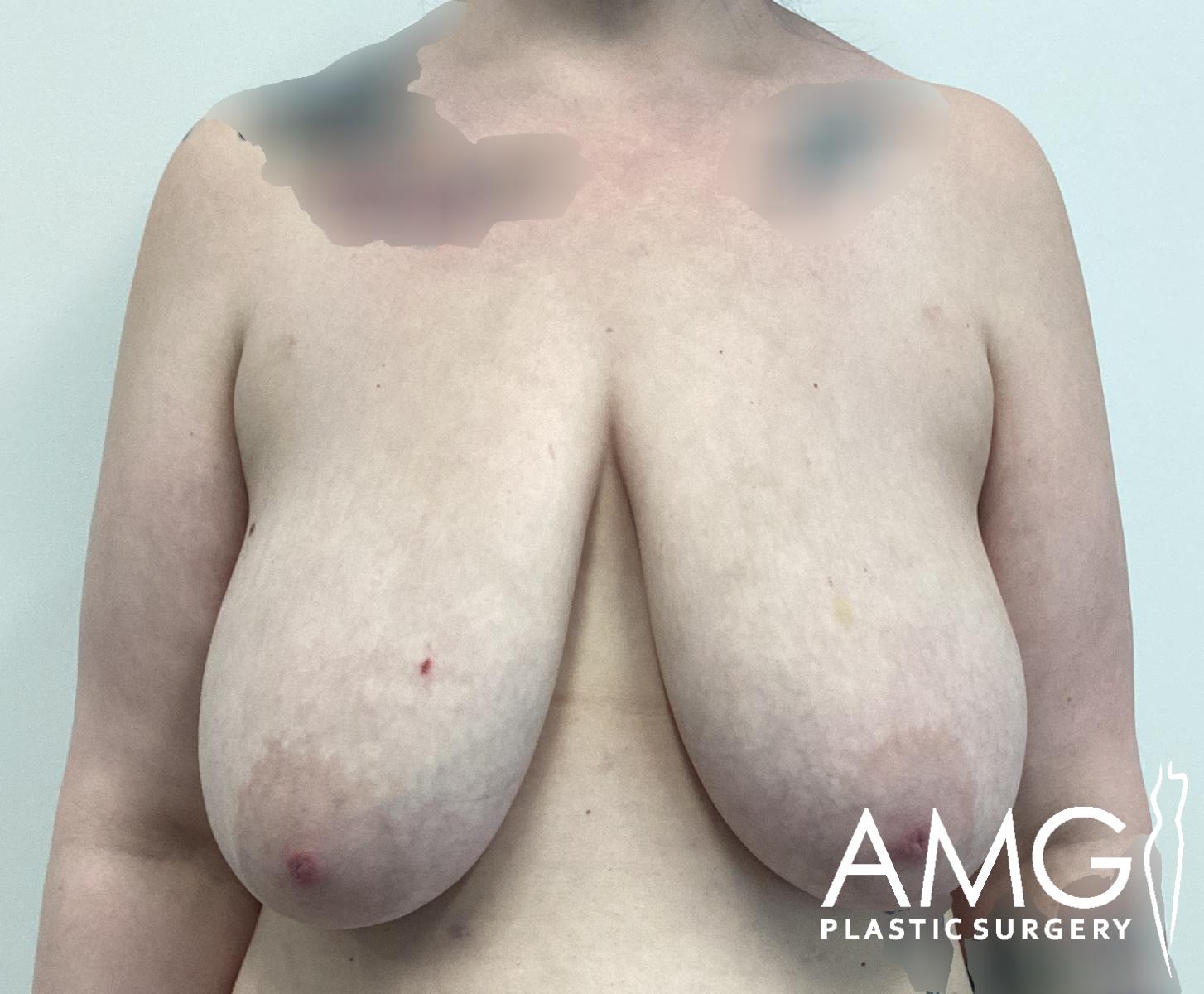 A person with large, natural breasts is shown from the shoulders to the waist against a plain background. The AMG Plastic Surgery logo appears in the bottom right corner. Identifying features on the chest are blurred.