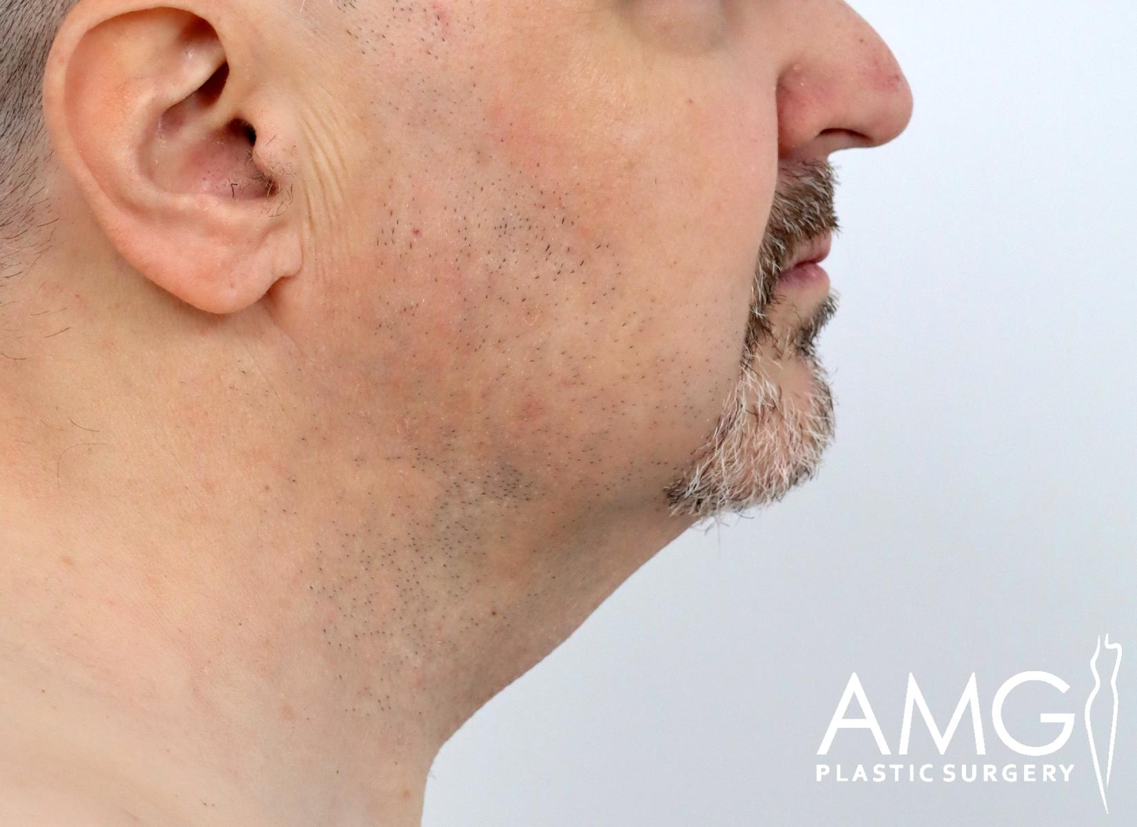 Side profile of a middle-aged mans lower face and neck, showing some facial hair and loose skin under the chin. The image includes the AMG Plastic Surgery logo in the bottom right corner.