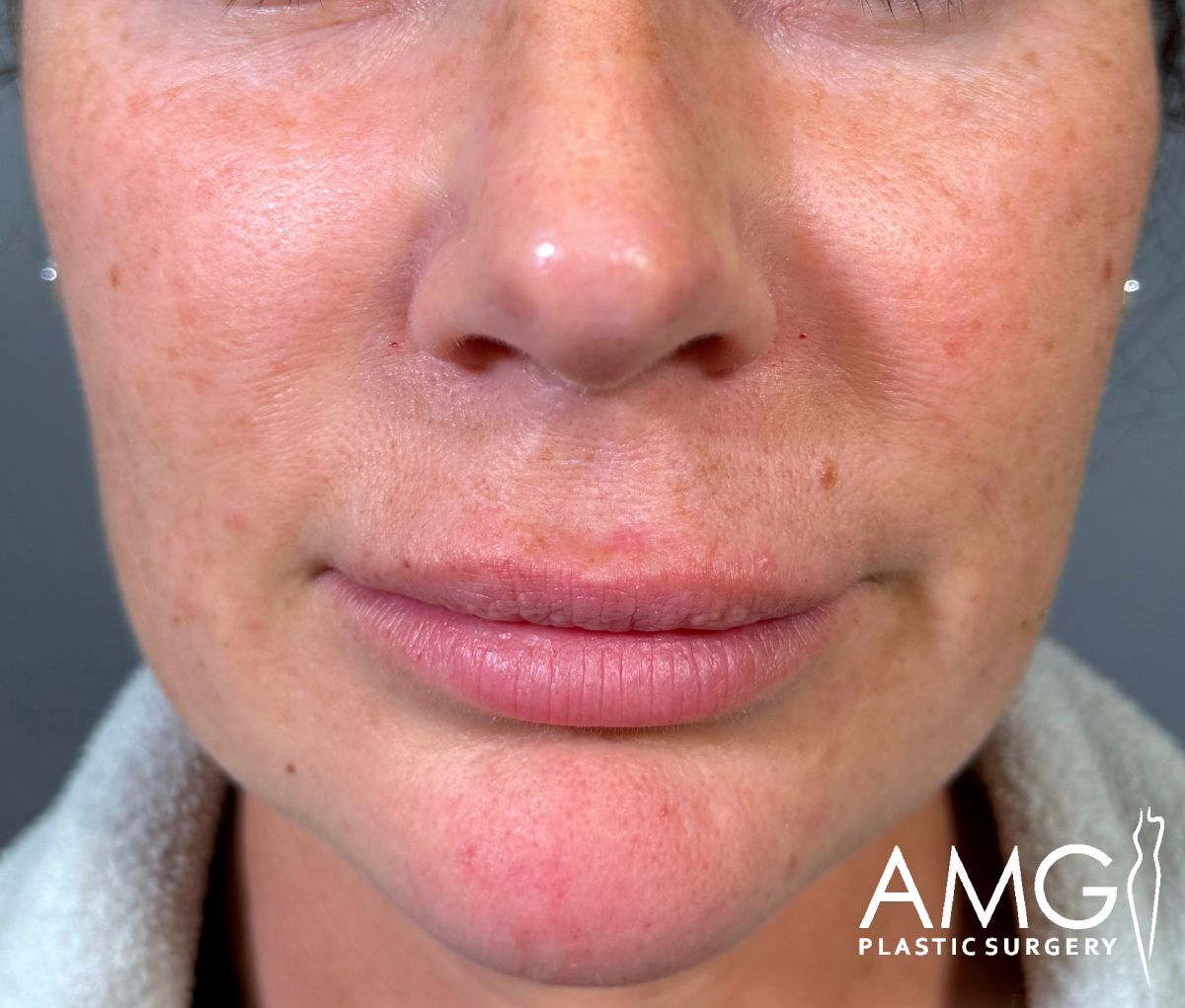 Close-up of a womans lower face showing natural lips, light freckles, and slight redness on the chin. The AMG Plastic Surgery logo is visible in the bottom right corner.