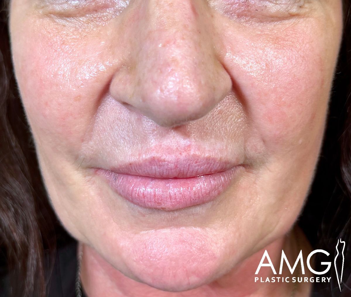 Close-up of the lower half of a woman’s face, showing her nose, lips, and chin with smooth skin. The AMG Plastic Surgery logo appears in the bottom right corner.
