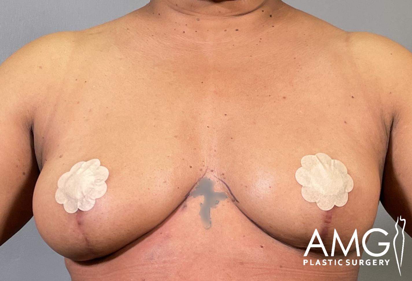 Front view of a woman's torso after breast lift showing lifted breasts, AMG Plastic Surgery.