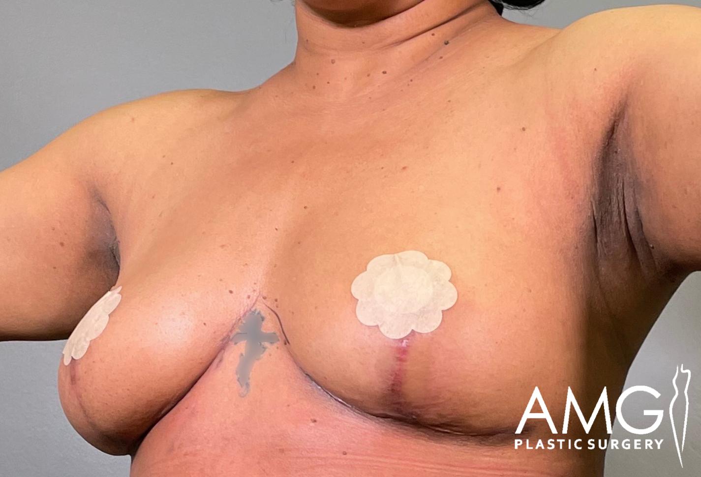 Left oblique view of a woman's torso after breast lift showing lifted breasts, AMG Plastic Surgery.