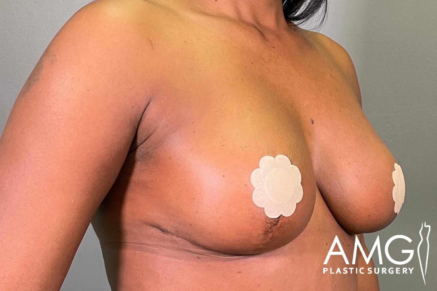 Right oblique view of a woman's torso after breast lift showing lifted breasts, AMG Plastic Surgery.