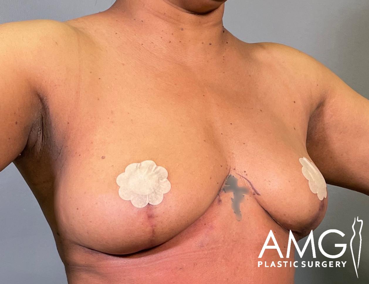 Right oblique view of a woman's torso after breast lift showing lifted breasts, AMG Plastic Surgery.