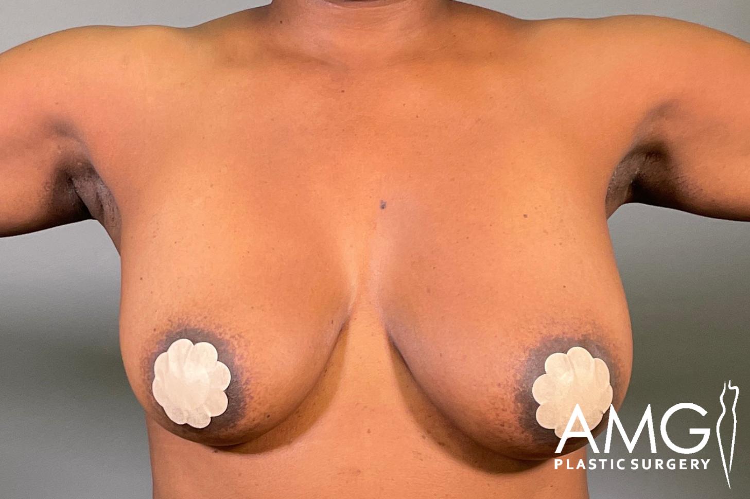 Front view of a woman's torso before breast lift showing breast ptosis, AMG Plastic Surgery.