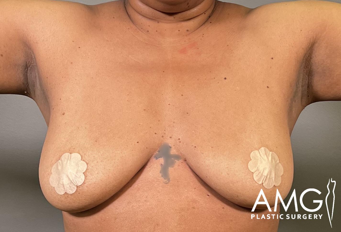 Front view of a woman's torso before breast lift showing breast ptosis, AMG Plastic Surgery.