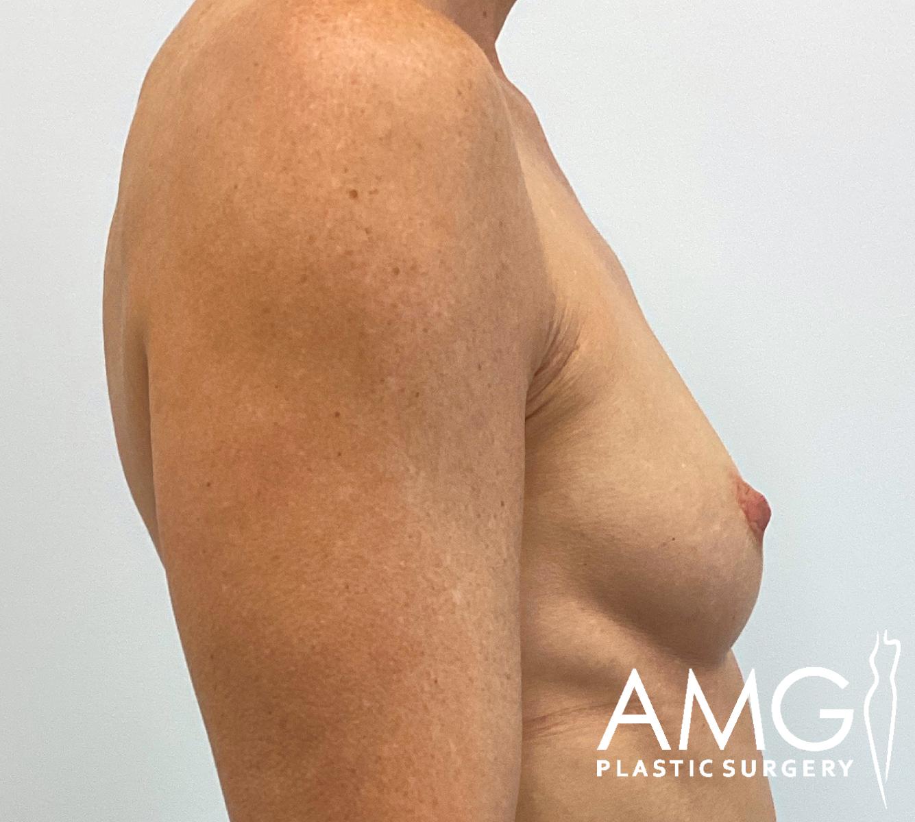 Breast Augmentation before surgery – right side view, AMG Plastic Surgery
