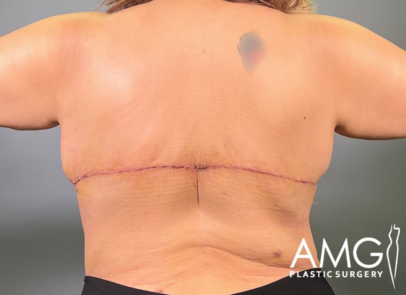 Back Lift after surgery – back view, AMG Plastic Surgery