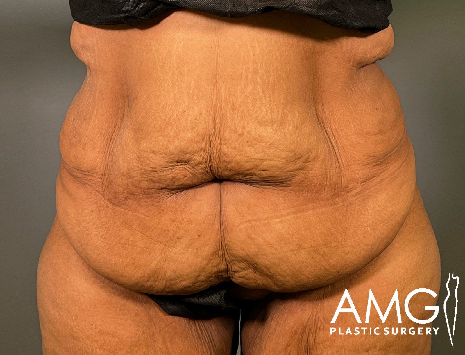 Front view of a woman's abdomen before fleur-de-lis tummy tuck showing excess skin and reduced abdominal contour, AMG Plastic Surgery.
