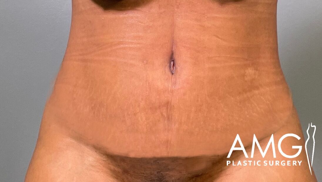 Tummy Tuck after surgery – front view, AMG Plastic Surgery