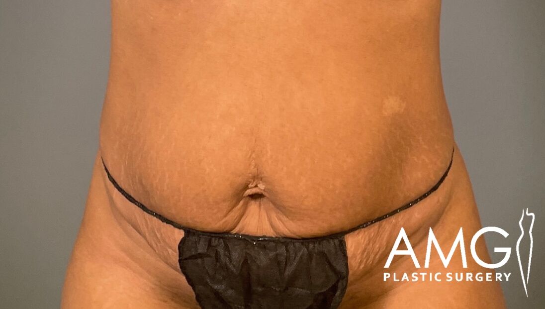 Tummy Tuck before surgery – front view, AMG Plastic Surgery