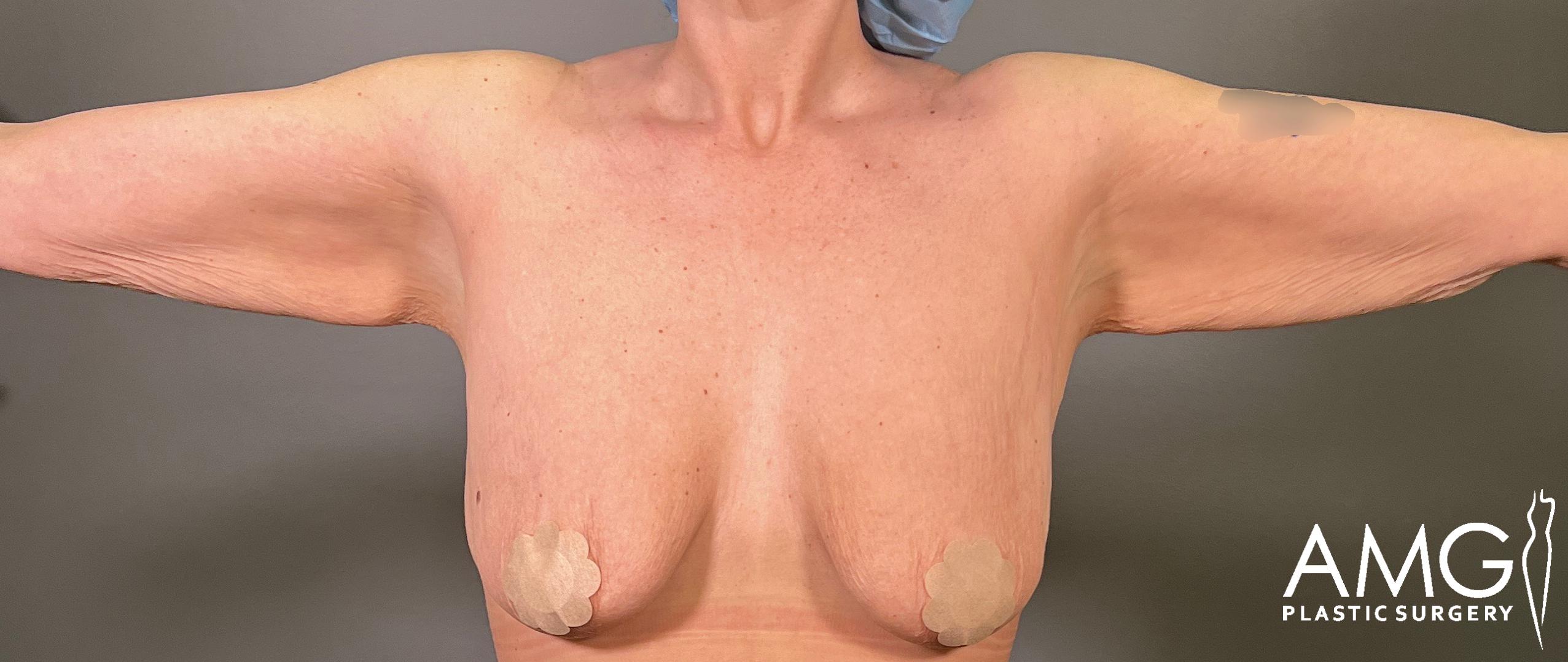 Upper Body Lift before surgery – front view, AMG Plastic Surgery