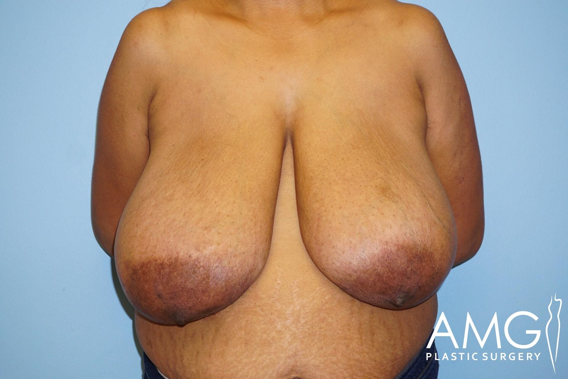 Person with significant breast hypertrophy standing against a blue background, with a logo reading 